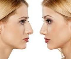 Transform Your Profile with Expert Rhinoplasty Surgery in Delhi