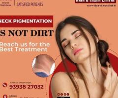 facial port wine stain Treatment in india