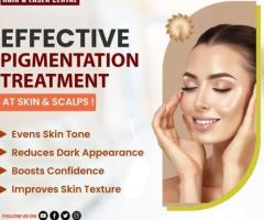 facial port wine stain Treatment in india