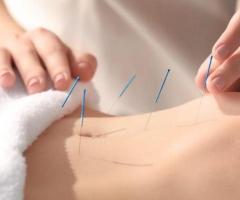 Best Fertility Acupuncture NYC