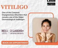 best advanced acne laser treatment in india