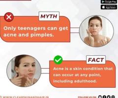 best Vitiligo Treatments in india