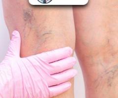 Best Varicose Veins Treatment in Gujarat, India - Dr. Krunal Gohil