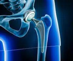 best joint replacement surgeons in Jaipur,