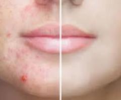 Top Psoriasis Specialist Doctor in Ahmedabad, Gujarat for Long-Term Relief
