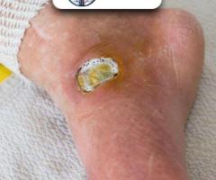 Expert Care for Diabetic Foot in Gujarat, India