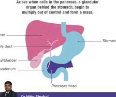 Pancreatic Cancer Treatment in Ahmedabad, India: Smart Approach