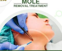 Best Advanced Acne Laser Treatment in India