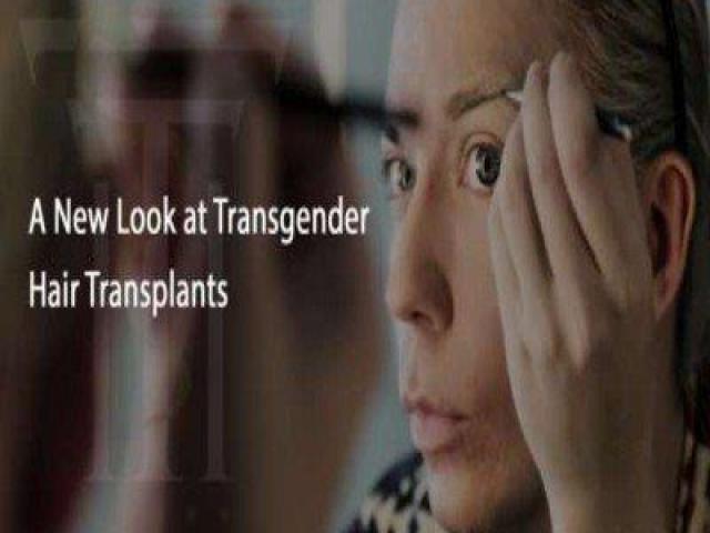 Transgender Hair Transplants In Florida