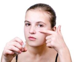 Quick Targeted Solution for Stubborn Pimples