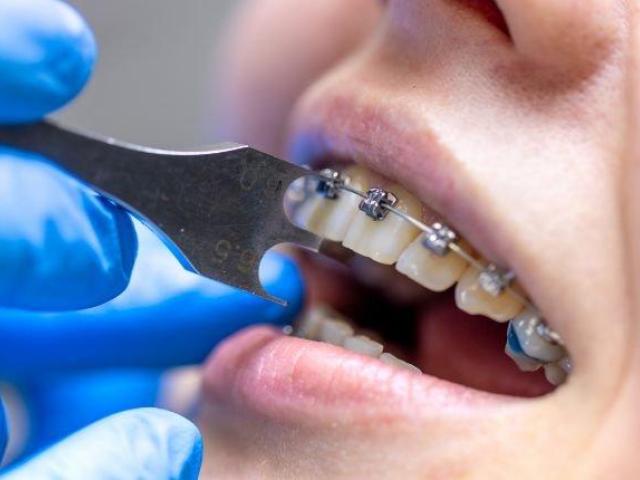 Dental Braces Treatment in Ahmedabad | Expert Care at Somani's Orthodontic & Dental Clinic