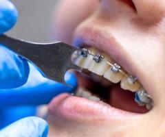 Dental Braces Treatment in Ahmedabad | Expert Care at Somani's Orthodontic & Dental Clinic