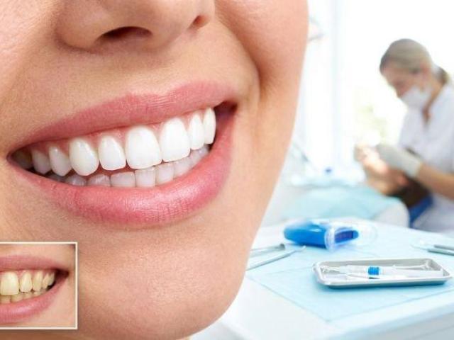 Somani’s Orthodontic & Dental Clinic – Teeth Whitening Price in Ahmedabad for Confident Smiles
