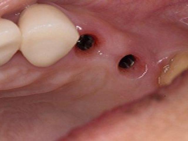 Find Trustworthy Teeth Replacements with Tijuana Dental Implants