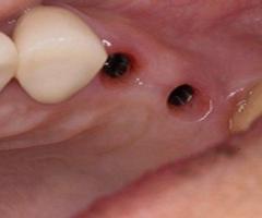 Find Trustworthy Teeth Replacements with Tijuana Dental Implants