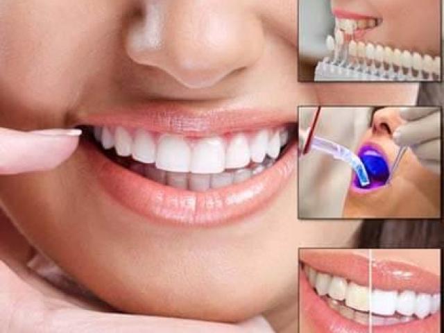 Implant Crowns Treatment in Whittier, California