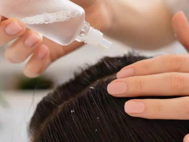 Best Hair Clinic For Anti-Dandruff Treatment In Coimbatore