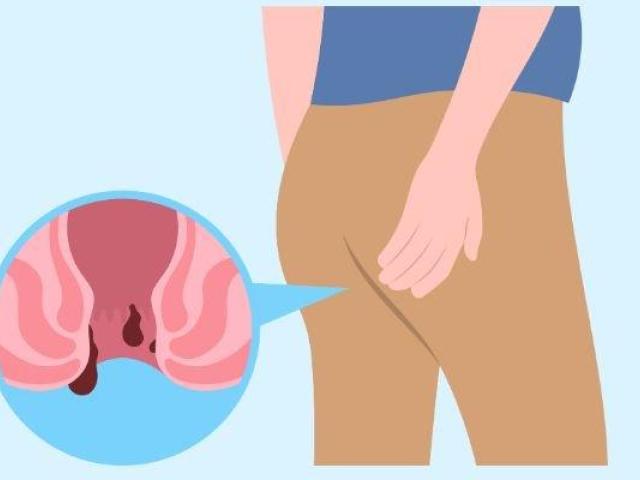 Piles clinic in noida