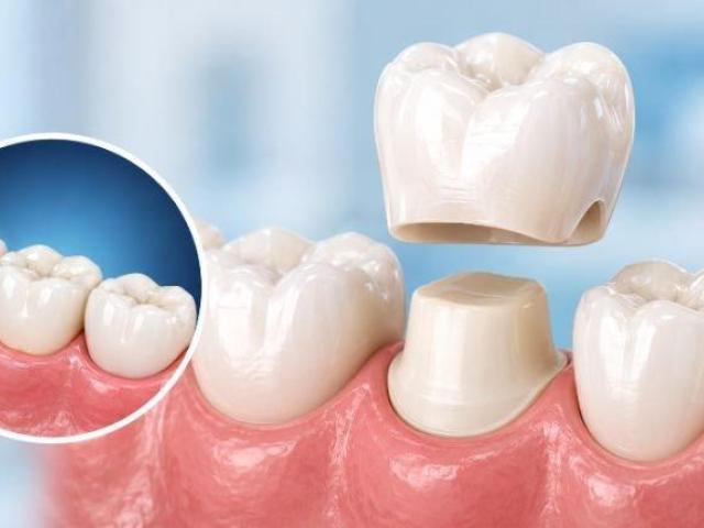 Dental Caps (Crowns) in South Bopal, Ahmedabad for Damaged Teeth | The Tooth Studio