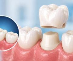 Dental Caps (Crowns) in South Bopal, Ahmedabad for Damaged Teeth | The Tooth Studio
