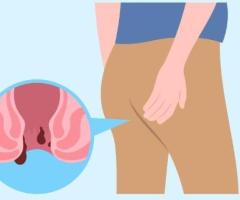 Expert Ano-Rectal Treatment in Noida for Piles & Fissure