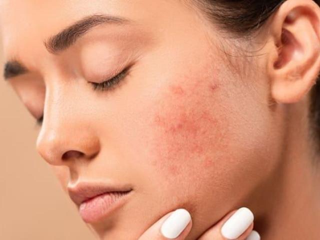 Best Acne treatment in Hyderabad - FMS skin & hair