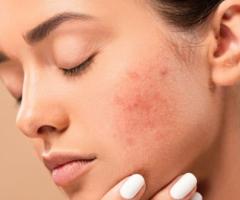 Best Acne treatment in Hyderabad - FMS skin & hair