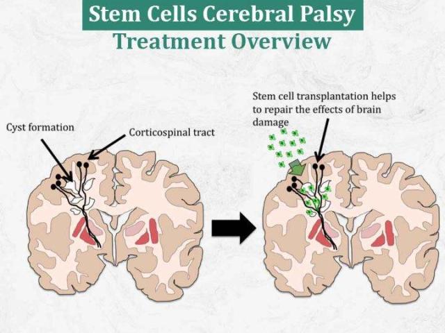 Stem Cells Cerebral Palsy Treatment Overview