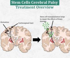 Stem Cells Cerebral Palsy Treatment Overview