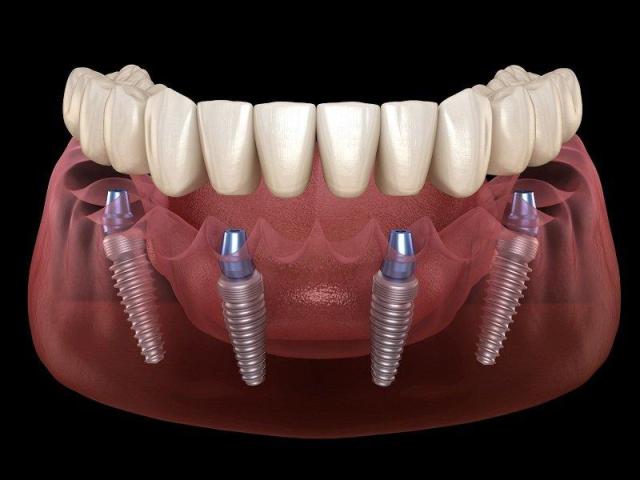 All-on-4 Dental Implants in Tijuana, Mexico – Affordable, Life-Changing Results!