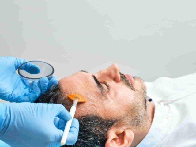 Best Chemical Peel Treatment in Bengaluru