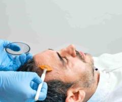 Best Chemical Peel Treatment in Bengaluru