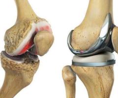 Best Knee Replacement Surgeon in Mansarovar