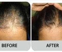Available Regrowth & Baldness Treatment