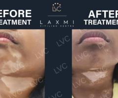 Best Doctor & Best Homeopathic Vitiligo Treatment and Packs.